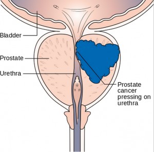 A diagram of prostate cancer pressing on the urethra, which can cause symptoms. Image-Cancer Research UK / Wikimedia Commons