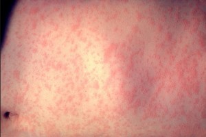 Measles rash. Image-Wikipedia