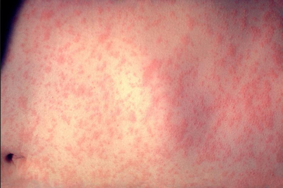 Measles Case in Fairbanks Confirmed
