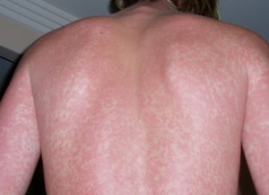A diffuse rash on a man's back. Image-Public Domain