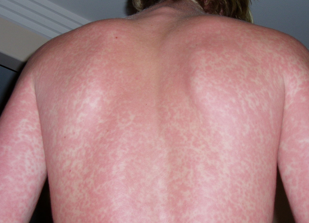 How to Tell if a Rash Needs Medical Attention