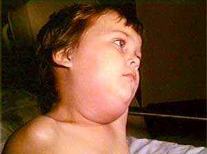 Child with Mumps-CDC