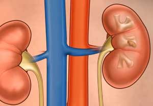 Illustration of kidney stones. Image-CHOP