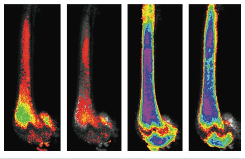 Diabetes drug boosts bone fat and fracture risk; exercise can partially offset the effect