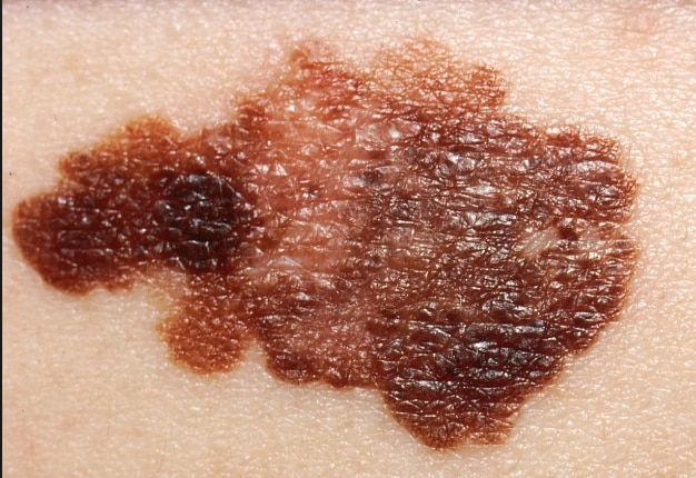 Research Reveals How Melanoma Spreads to Other Organs