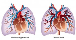 Image showing the differance between a normal functioning heart and one with Pulmonary Hypertension. Image-CDC