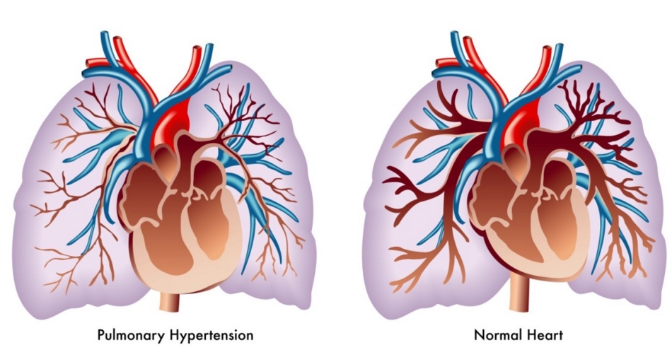 Study: Positive Results for New Oral Drug for Pulmonary Hypertension