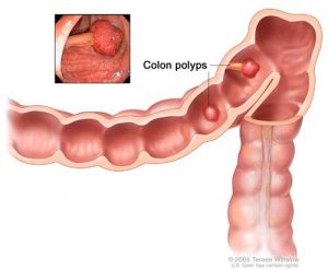 Illustration of Colon polyps.  Image-National Cancer Institute