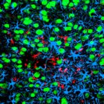 Study Details Brain Damage Triggered by Mini-Strokes