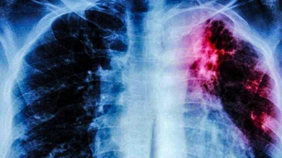 Alaska Ranks Highest in New National Data on Tuberculosis Rates