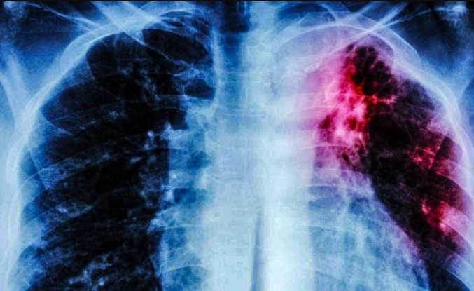 Alaska Ranks Highest in New National Data on Tuberculosis Rates