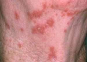 Shingles. Image-CDC