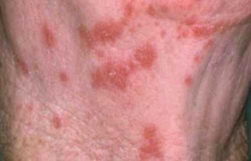 Shingles Associated With Increased Risk for Stroke, Heart Attack