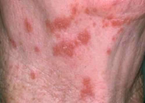 Shingles Associated With Increased Risk for Stroke, Heart Attack
