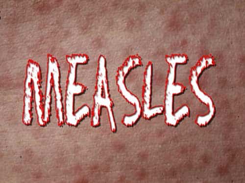Measles Case in Cruise Ship Passenger